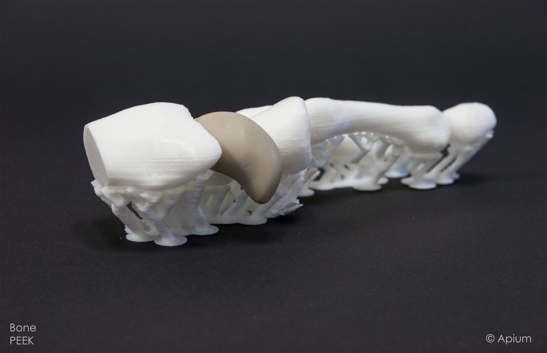 3D printed PEEK finger implant