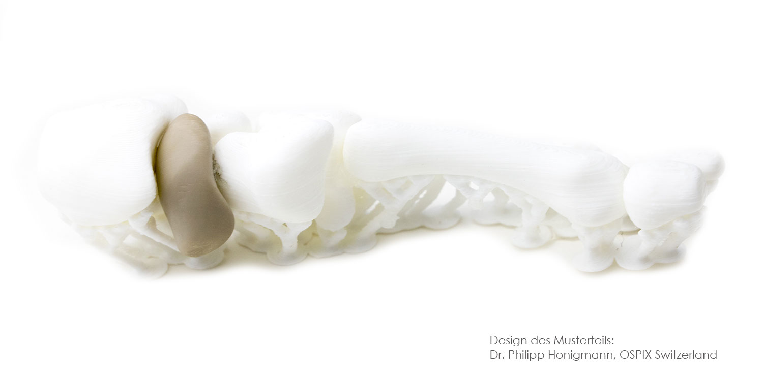 Osteosynthese und 3D-Druck - 3D gedrucktes Fingerimplantat aus PEEK
