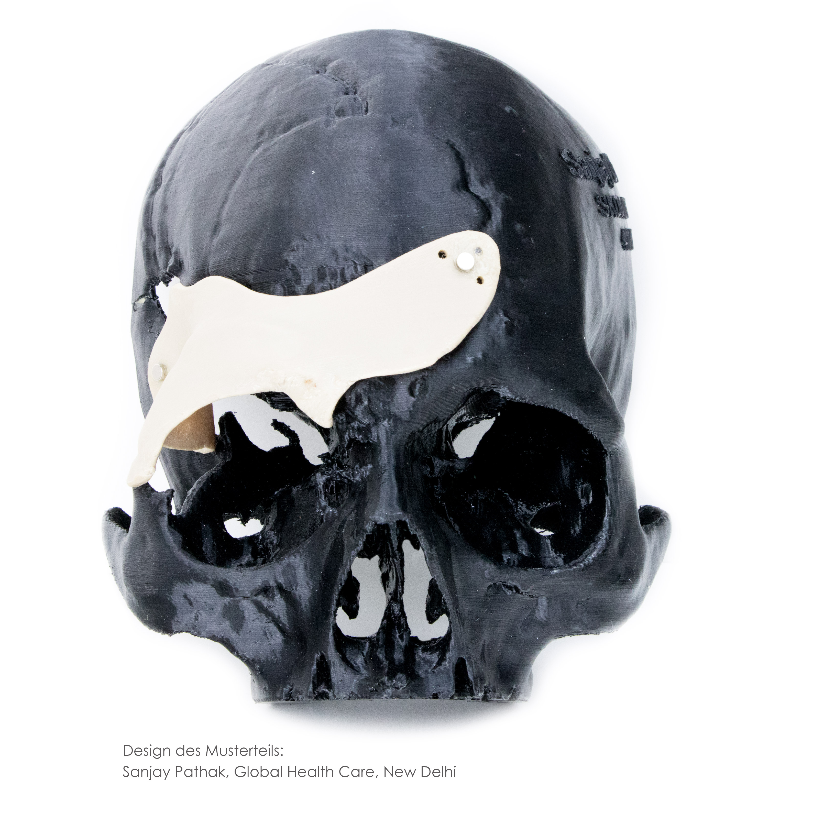 Osteosynthese und 3D-Druck - 3D gedrucktes Stirnimplantat aus PEEK